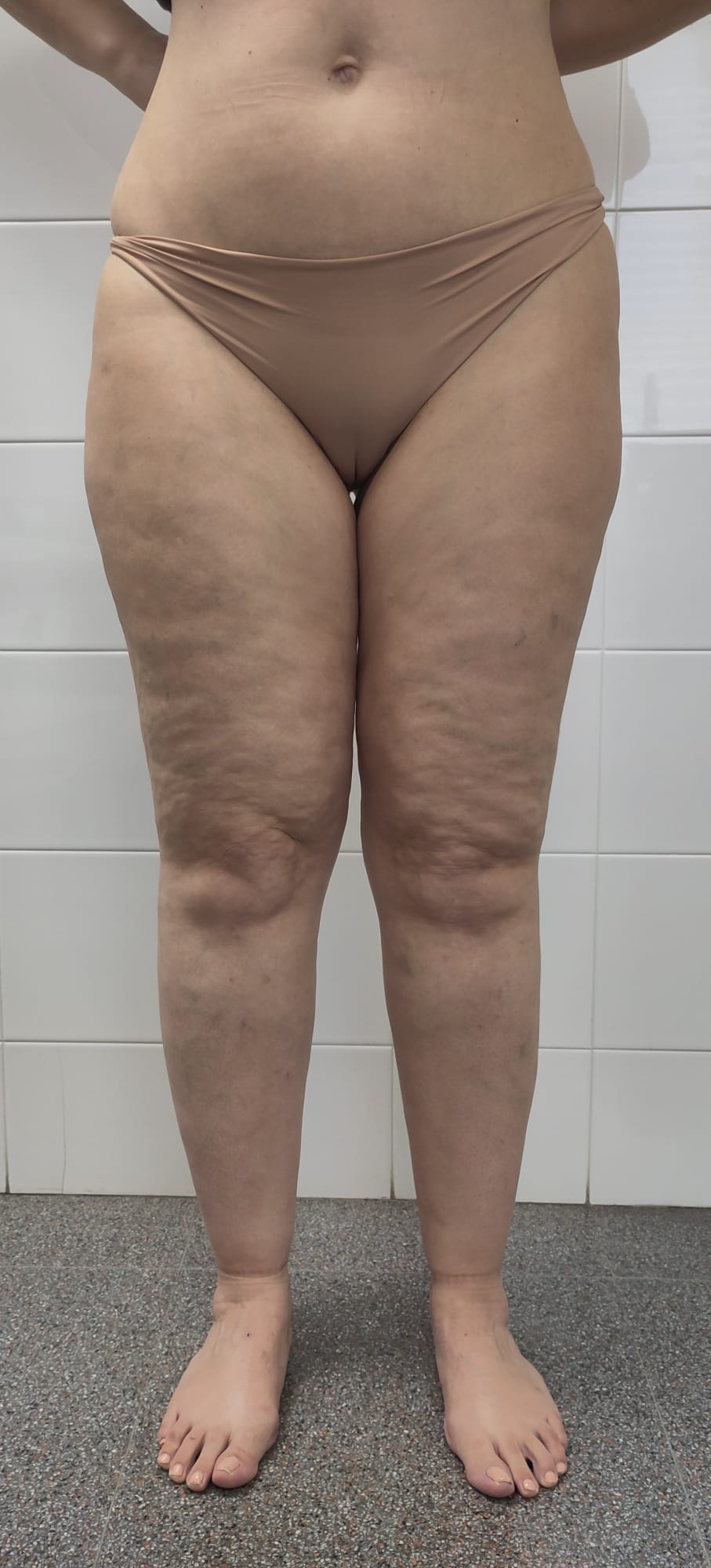 Imagem educativa das pernas de uma pessoa com lipedema